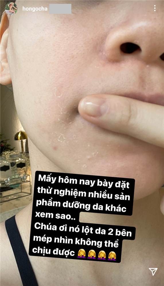 Làn da của Hà Hồ lãnh hậu quả không thể chịu được vì một lỗi skincare, nhiều chị em cũng mắc phải-2