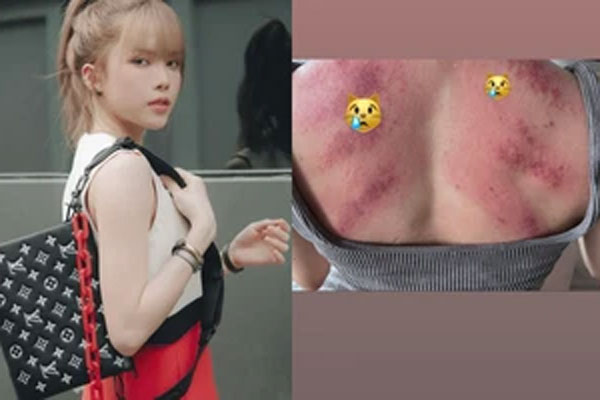 Vật vã giữa đêm, lưng bầm chi chít, Thiều Bảo Trâm hiện thế nào?-9