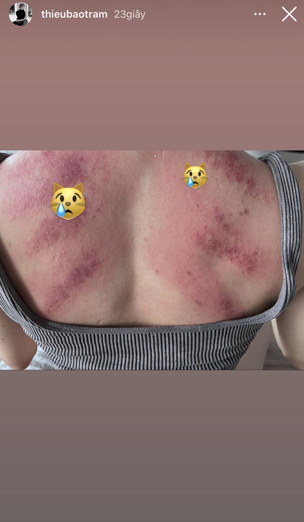 Đăng story cạo gió giữa drama, Thiều Bảo Trâm bị antifan quá khích chỉ trích vì nghi cố tình... làm màu-1