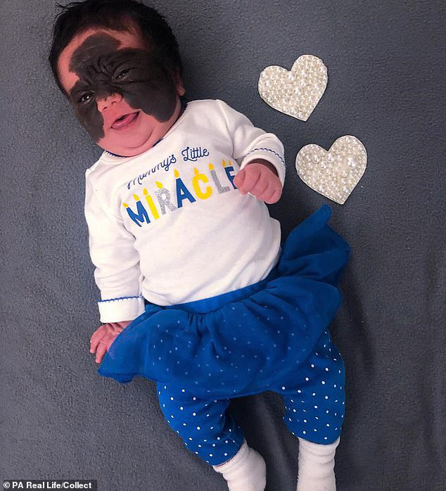 Bé gái có vết bớt đen khổng lồ trên khuôn mặt, gần 3 năm sau diện mạo thay đổi ra sao?-1