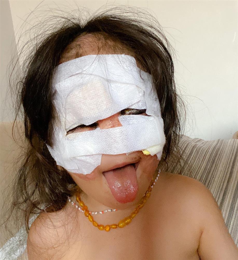 Bé gái có vết bớt đen khổng lồ trên khuôn mặt, gần 3 năm sau diện mạo thay đổi ra sao?-3