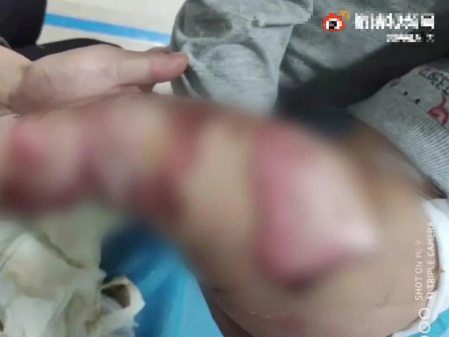 Bé trai 1 tuổi tè dầm và bị bỏng nặng: Khi trời trở lạnh, hãy coi chừng vật dụng này sẽ trở thành vũ khí giết người-1