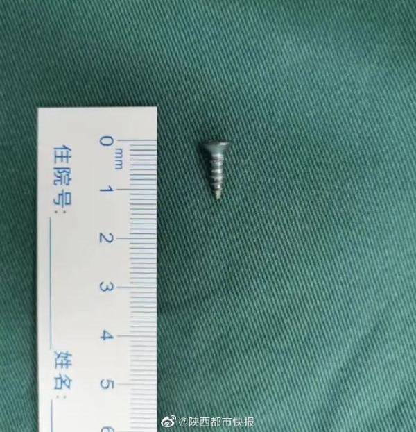 Em bé 10 tháng tuổi nuốt dị vật này vào bụng, bác sĩ nói: Thứ này đáng sợ hơn nhiều so với những loại dị vật khác”-2