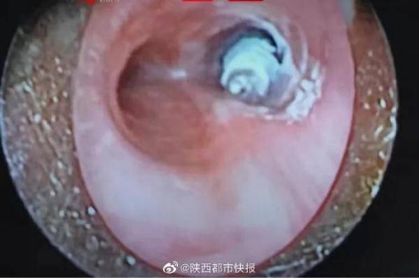 Em bé 10 tháng tuổi nuốt dị vật này vào bụng, bác sĩ nói: Thứ này đáng sợ hơn nhiều so với những loại dị vật khác”-3