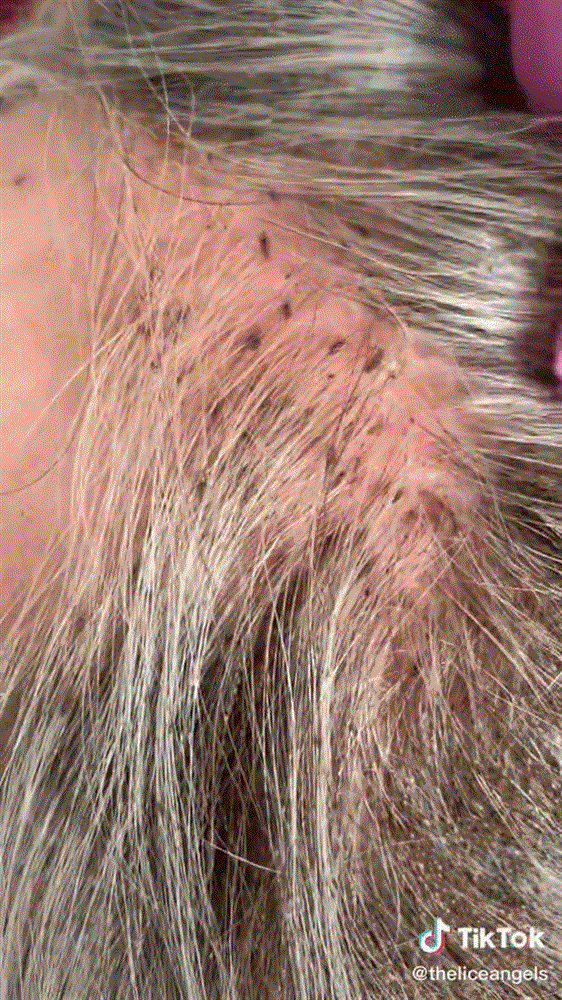 Cụ bà mang mái tóc lúc nhúc chấy đến cầu cứu, chuyên gia phải đưa ra quyết định cấp tốc trong video cực viral 76 triệu lượt xem-1