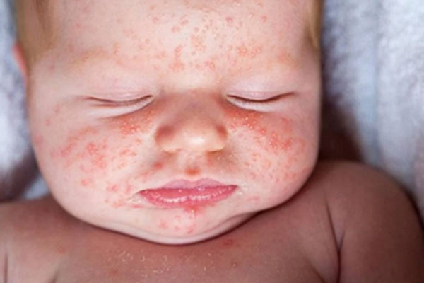 Triệu chứng lạ của trẻ nhỏ nhiễm biến thể Omicron-1