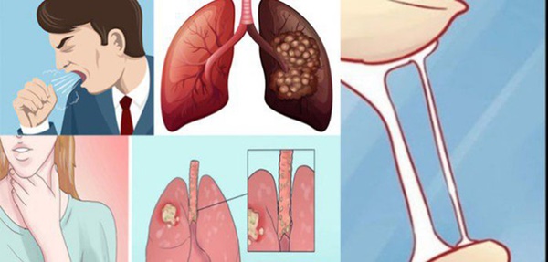 Thường xuyên xuất hiện 4 triệu chứng này thì có thể bạn đã bị ung thư phổi rồi, nhiều người chủ quan với dấu hiệu 3 khiến bệnh nặng thêm-1