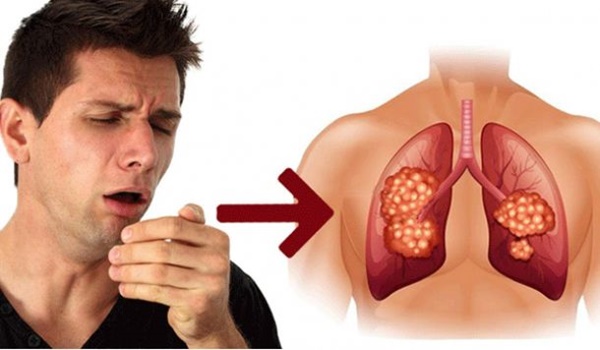 Thường xuyên xuất hiện 4 triệu chứng này thì có thể bạn đã bị ung thư phổi rồi, nhiều người chủ quan với dấu hiệu 3 khiến bệnh nặng thêm-2