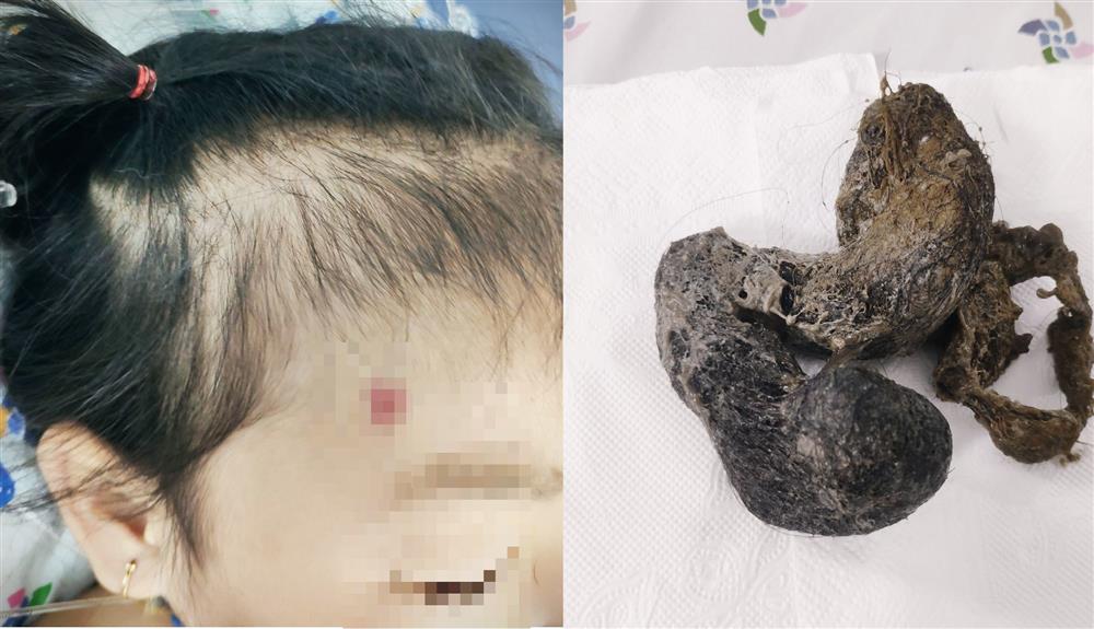 Bé gái 4 tuổi cấp cứu vì hội chứng cô bé tóc mây hiếm gặp-1