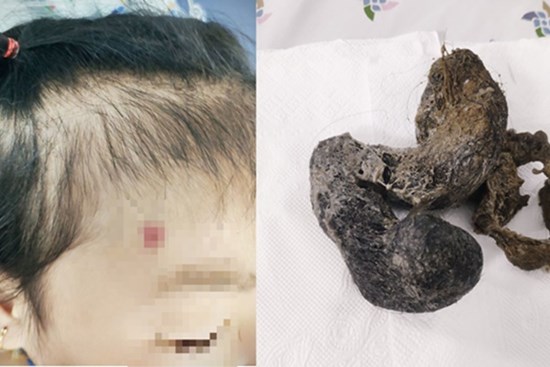 Bé gái 4 tuổi cấp cứu vì hội chứng 