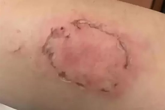 Đi đổ xăng, thanh niên bị kẻ lạ lao vào cắn mặt, xé nát quần lót