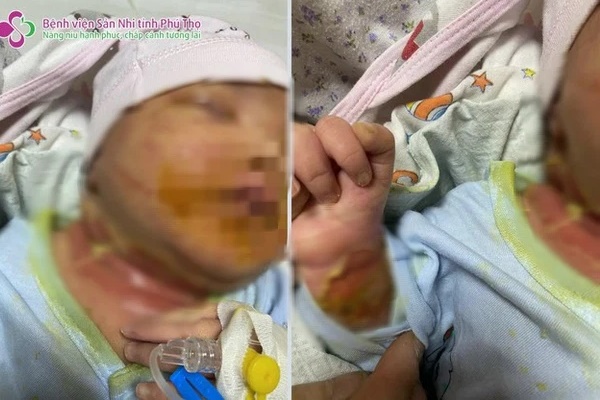 Sợ COVID-19, mẹ tự điều trị cho con khiến bé sơ sinh loét hết mắt, nghi nhiễm trùng máu-2