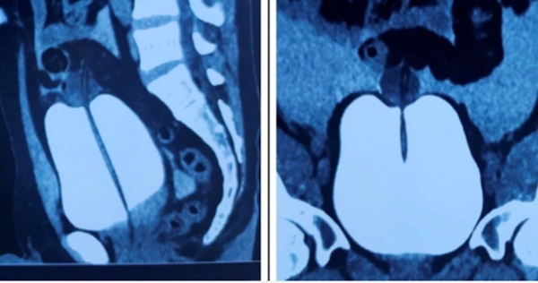 Sau cuộc nhậu, nam thanh niên 29 tuổi phải nhập viện cấp cứu vì vỡ bàng quang-1