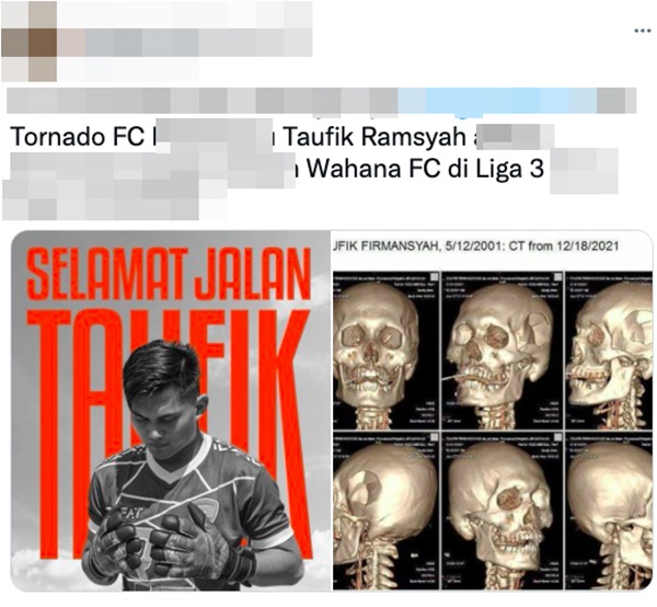 Lộ ảnh X-quang sọ mặt của thủ môn Indonesia trước khi tử vong: Vùng đầu bên trái biến dạng nghiêm trọng?-1