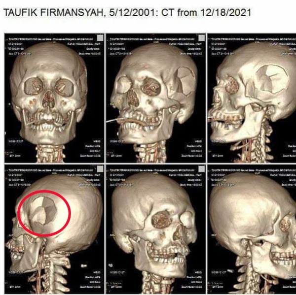 Lộ ảnh X-quang sọ mặt của thủ môn Indonesia trước khi tử vong: Vùng đầu bên trái biến dạng nghiêm trọng?-2