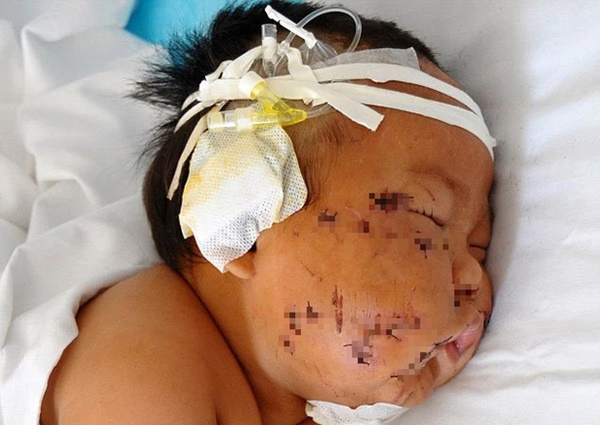 Em bé từng bị mẹ đâm gần 90 nhát kéo vào mặt vì cắn ti khi đang bú khiến dư luận khắp nơi bàng hoàng giờ ra sao?-1