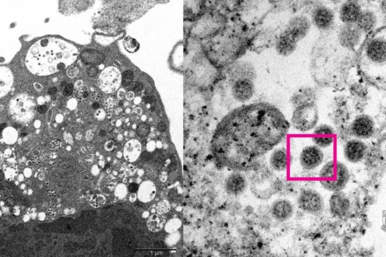 Triệu chứng COVID-19 đặc trưng dần biến mất trên biến thể Omicron