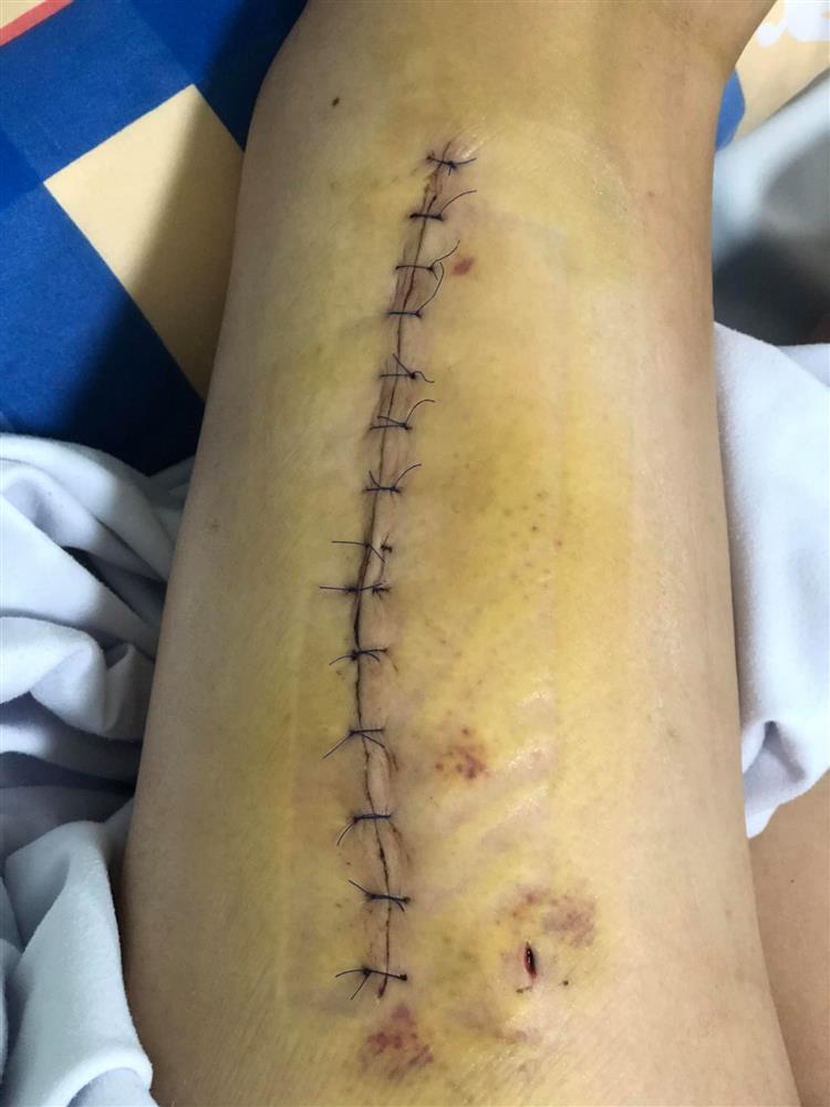 Người phụ nữ bị gãy xương đùi khi đi trị liệu lên tiếng: Là người khuyết tật, u uất vì bị hiểu nhầm thành đi massage đến mức 1 là kiện, 2 là sẽ tự tử-1