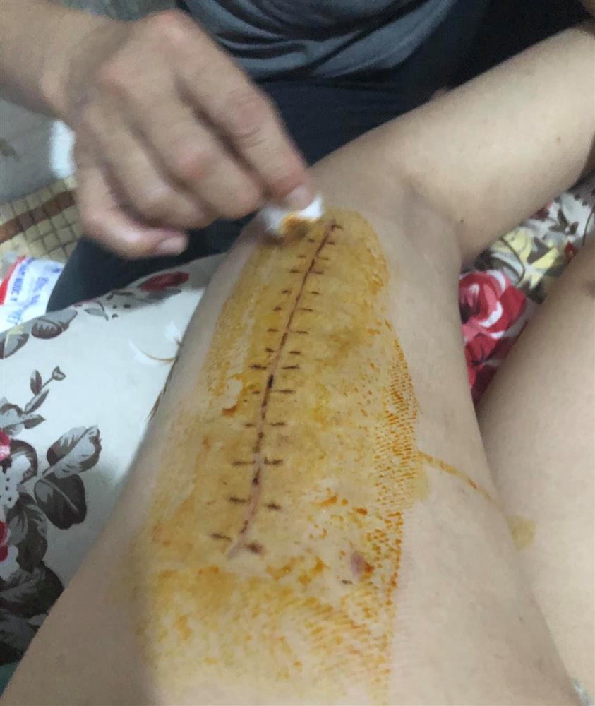 Người phụ nữ bị gãy xương đùi khi đi trị liệu lên tiếng: Là người khuyết tật, u uất vì bị hiểu nhầm thành đi massage đến mức 1 là kiện, 2 là sẽ tự tử-2