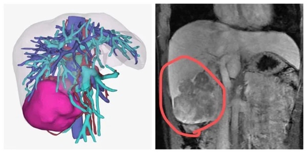 Cô gái 22 tuổi phải cắt bỏ nửa lá gan vì bị ung thư, nguyên nhân xuất phát từ 2 thói quen thường ngày của nhiều người trẻ-2