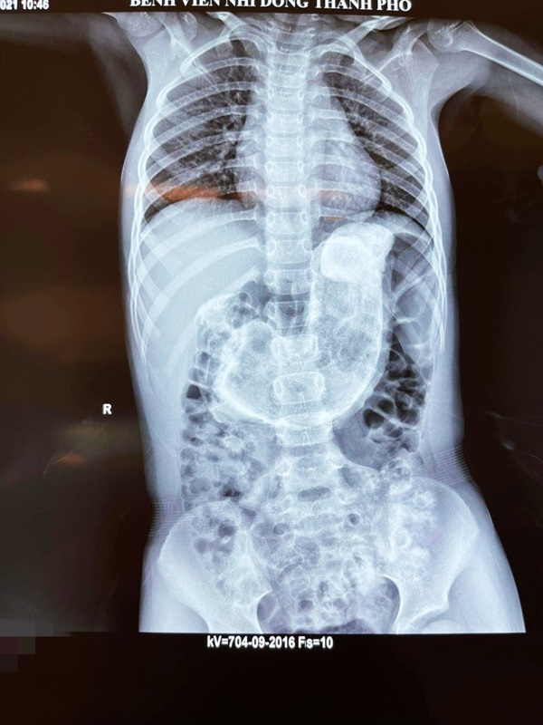 Bé gái 5 tuổi nhập viện phát hiện búi tóc gần 1 kg trong dạ dày, nguyên nhân đau lòng đến từ sự thiếu quan tâm của bố mẹ-1