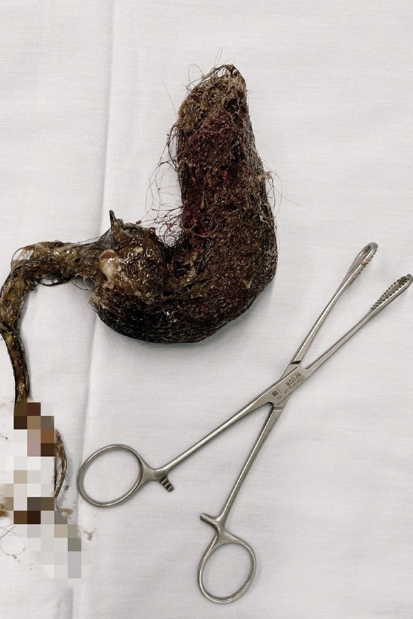 Bé gái 5 tuổi nhập viện phát hiện búi tóc gần 1 kg trong dạ dày, nguyên nhân đau lòng đến từ sự thiếu quan tâm của bố mẹ-2