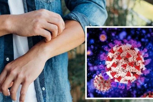 Cảnh báo triệu chứng nhiễm Omicron trên da ít người biết, dễ bị bỏ qua-1