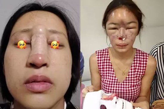 Review nâng mũi, cô gái gây hãi hùng khi nhìn thành quả