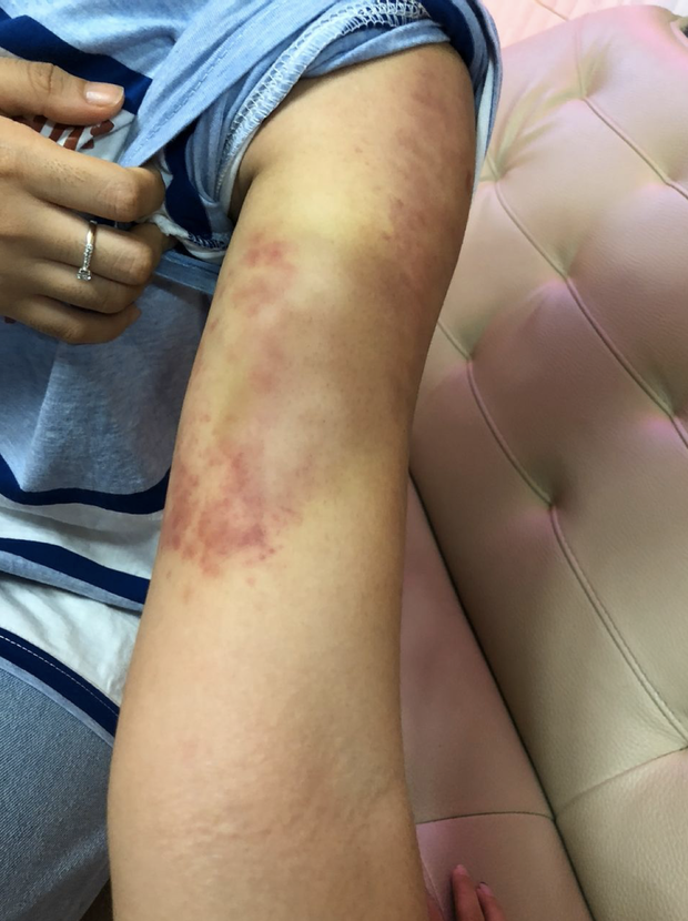 Phương Mỹ Chi lộ loạt dấu hiệu sức khoẻ đáng lo: Tay bầm tím, rụng tóc nghiêm trọng ở tuổi 18-2