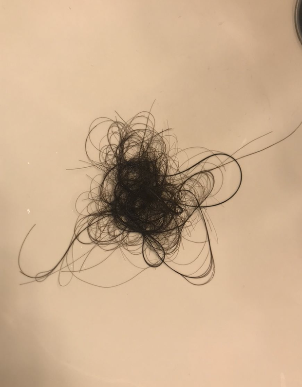 Phương Mỹ Chi lộ loạt dấu hiệu sức khoẻ đáng lo: Tay bầm tím, rụng tóc nghiêm trọng ở tuổi 18-4