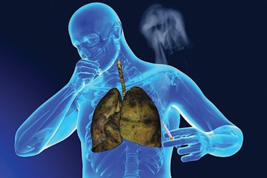 Ung thư phổi cực kỳ