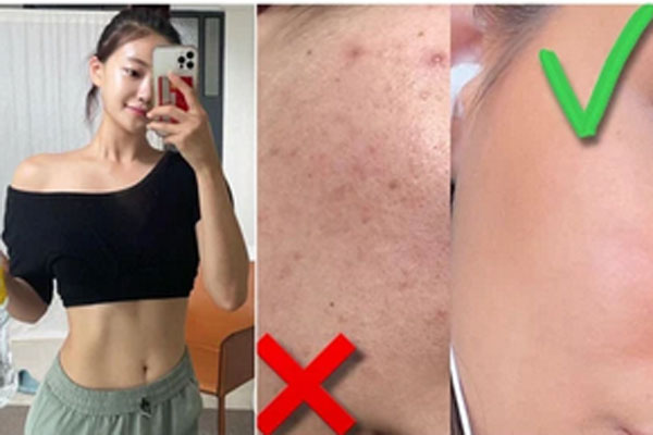 Cằm biến dạng đau đớn sau khi dán cao trị mụn-2