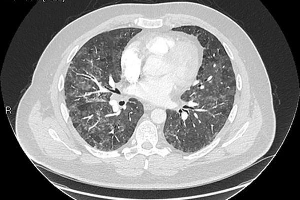 Khi bệnh phổi tìm đến bạn, sắc da sẽ chuyển sang một màu lạ, Bộ Y tế khuyến cáo làm 7 điều để phổi luôn sạch khỏe-6