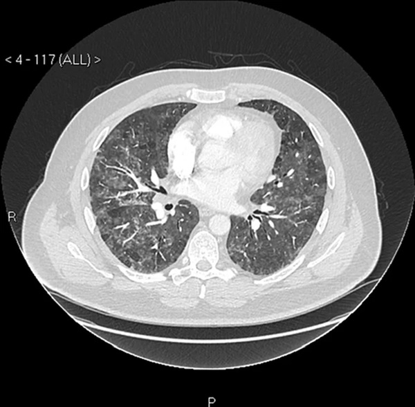 Người đàn ông bị viêm phổi nặng, khó thở trong thời gian dài vì 1 đồ vật mà chúng ta đầu ấp tay gối hàng ngày-2