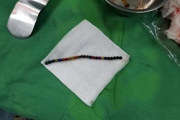 Nghệ An: Bé trai nuốt phải 25 viên bi nam châm vào ổ bụng-2