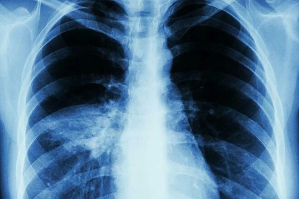Khi bệnh phổi tìm đến bạn, sắc da sẽ chuyển sang một màu lạ, Bộ Y tế khuyến cáo làm 7 điều để phổi luôn sạch khỏe-2