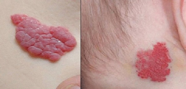 4 triệu chứng trên cổ ngầm cảnh báo tế bào ung thư đang nhen nhóm gõ cửa, bạn đừng chủ quan bỏ qua nhé!-1