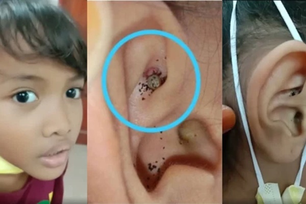 Cậu bé 6 tuổi đau nhức và nghe tiếng động lạ trong tai, đi nội soi bác sĩ hốt hoảng khi thấy con vật đang làm tổ bên trong-1