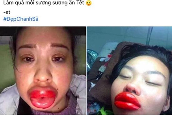 Gái xinh phun môi đón Tết và cái kết 'méo mỏ', sưng như bị đấm