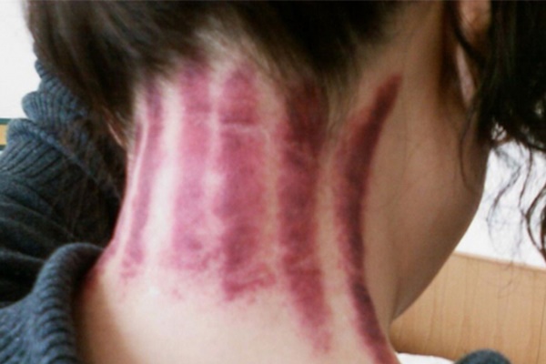 Khi nào nên cạo gió?-3