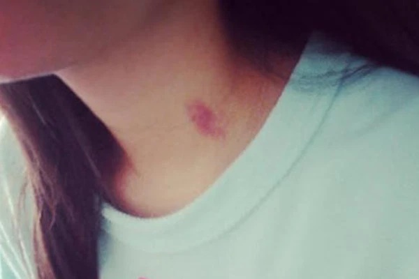 Phát hiện con gái có vết bầm tím lạ trên cổ, người bố tức giận mắng té tát, nghe con đáp lại 1 câu mà nghẹn lòng-1