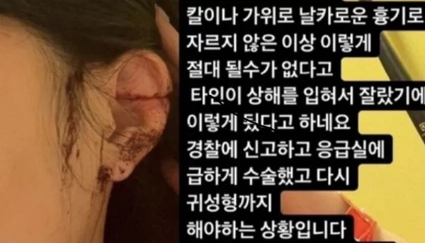 Chấn động Hàn Quốc: Cô gái đi vũ trường qua đêm, hôm sau tỉnh dậy thấy mình bị cắt tai-1