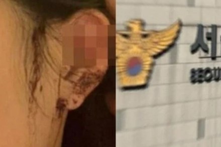 Chấn động Hàn Quốc: Cô gái đi vũ trường qua đêm, hôm sau tỉnh dậy thấy mình bị cắt tai