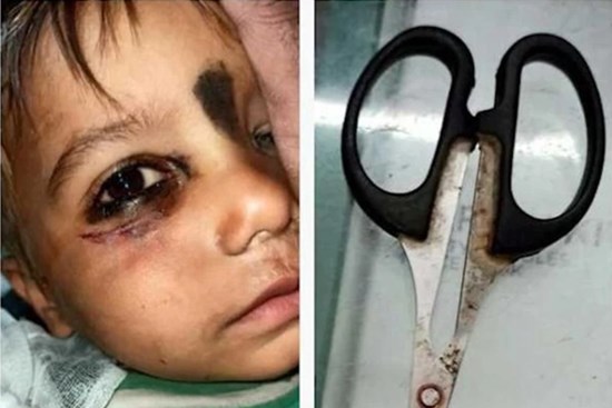 Bố mẹ bất cẩn khiến con trai bị tai nạn thương tâm, nhìn vết thương ai cũng phải xót xa cho đứa trẻ