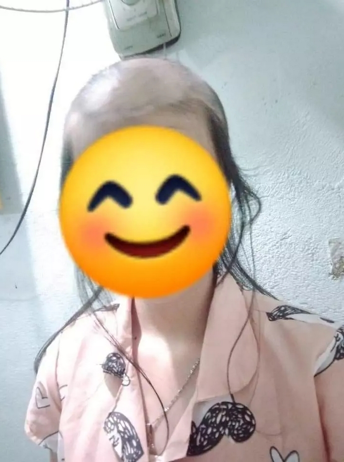 Sốc với mái đầu gần trụi nhẵn tóc của cô gái, xót xa khi biết là bởi 1 thói quen-5