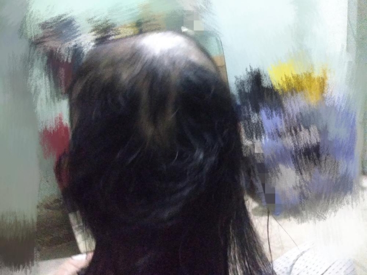 Sốc với mái đầu gần trụi nhẵn tóc của cô gái, xót xa khi biết là bởi 1 thói quen-3