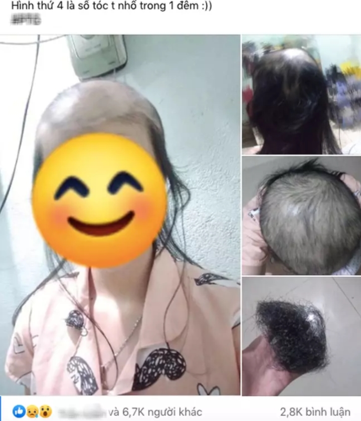 Sốc với mái đầu gần trụi nhẵn tóc của cô gái, xót xa khi biết là bởi 1 thói quen-1