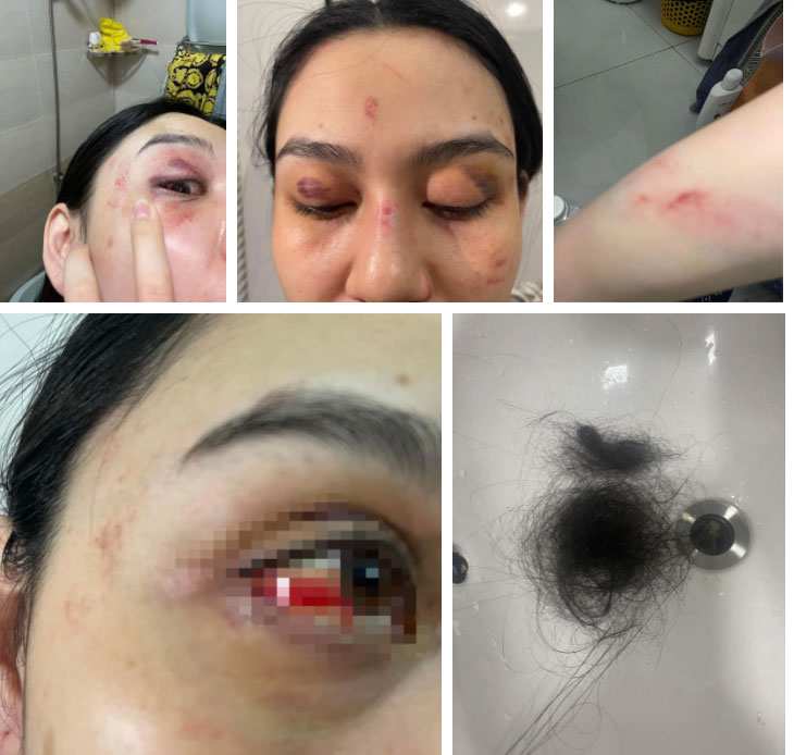 Xôn xao hình ảnh tình trạng hiện tại của người phụ nữ bị đánh dã man ở shop Trang Nemo-1