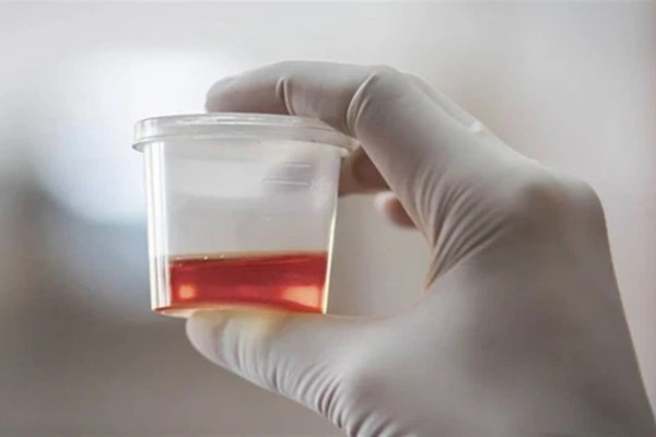 Người có thận hư rất dễ gặp phải 3 hiện tượng khi đi tiểu, xem ngay bạn có triệu chứng nào không-3