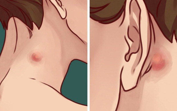 3 thay đổi bất thường trên cổ đang ngầm cảnh báo tế bào ung thư chực chờ trỗi dậy, chiếm lấy cơ thể bạn-3